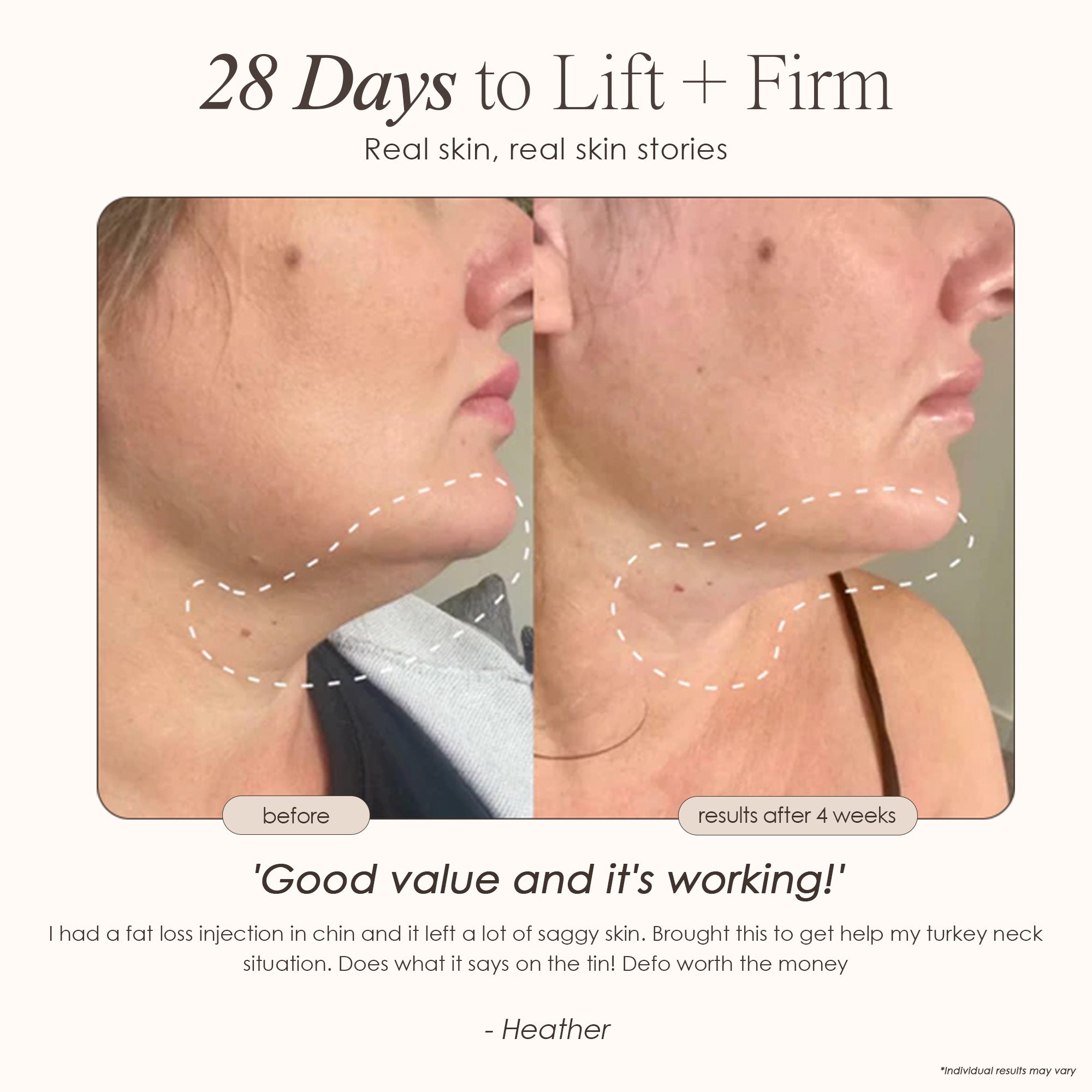 MesoLift | Mesotherapy Wonder Wand - Project E Beauty