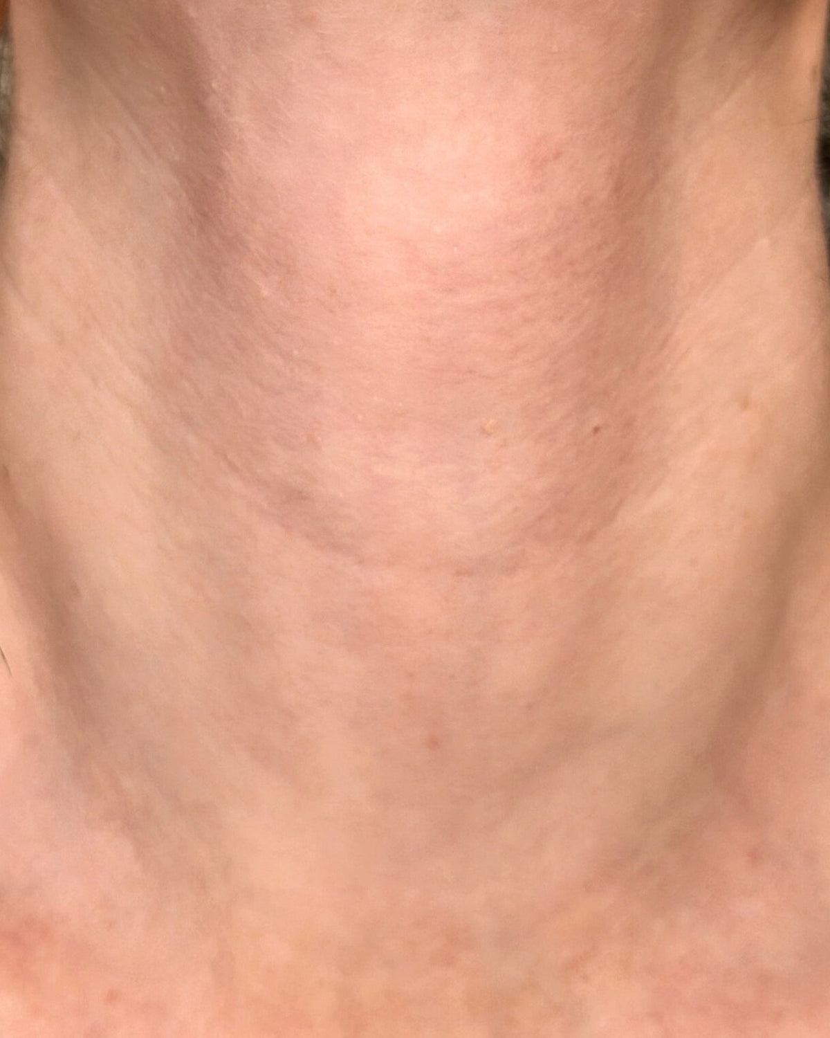 Xenia's neck after 4 weeks of LumaLux Face+
