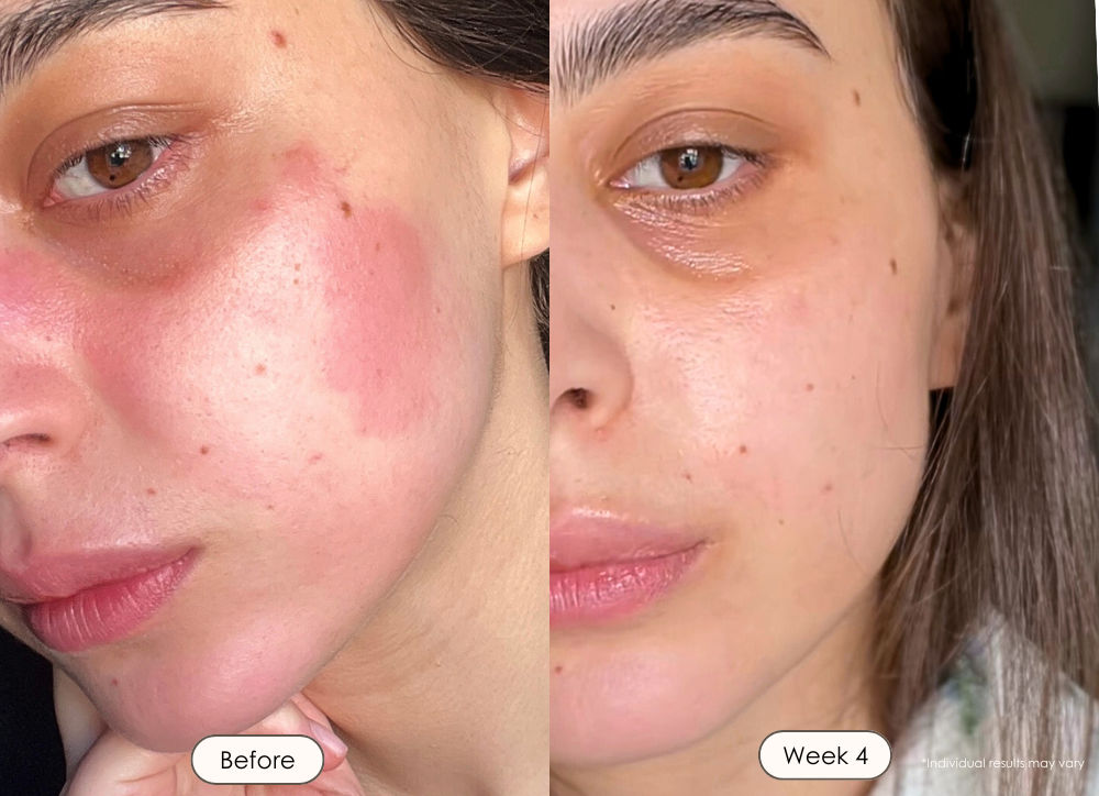 visible results after 30 days of using the LED light therapy mask