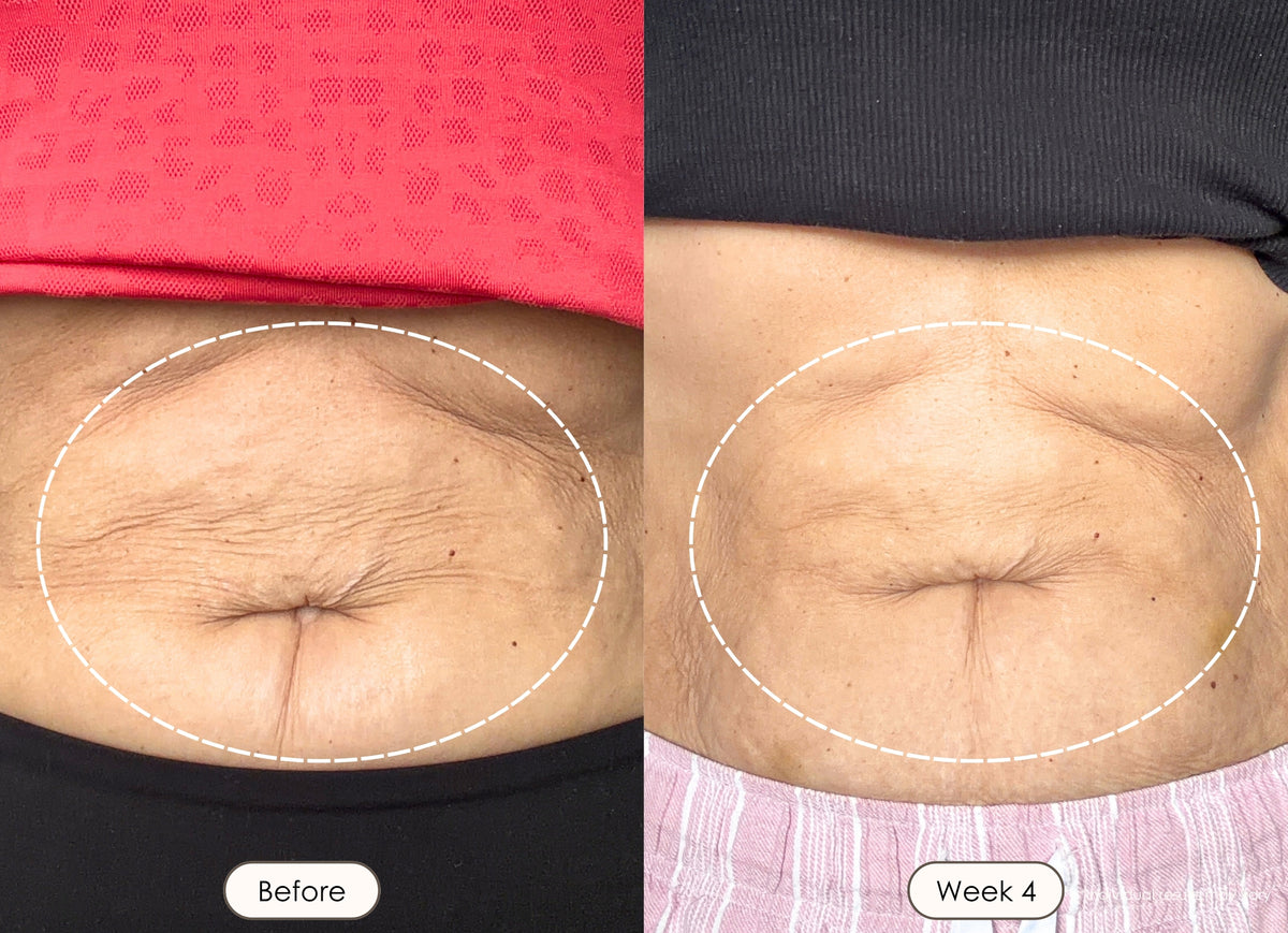 Woman showing smoother stomach skin around navel, before and after 4 weeks of using red led light therapy.